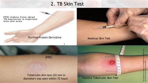 scratch test tb|tb skin test for what.